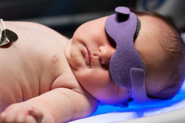 Phototherapy for Newborn Jaundice – Explanations for Parents. – NeoPedEdu