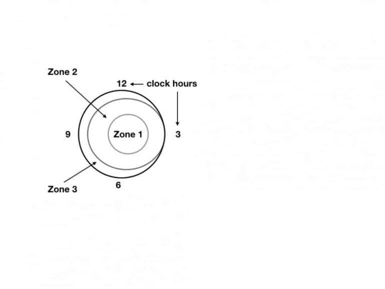 Retinopathy Of Prematurity (ROP) Guide For Parents NeoPedEdu